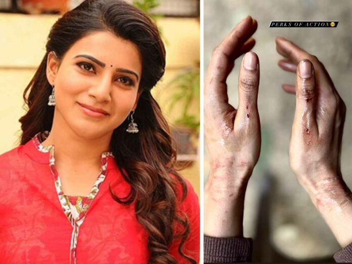 Samantha shares her bruises; calls 'perks of action'